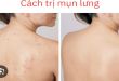 Trị Thâm Lưng Bằng Laser Có Đau Không? Sự Thật Bạn Cần Biết