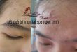 Bí Quyết Trị Mụn Hiệu Quả Tại Spa: Tự Tin Tỏa Sáng