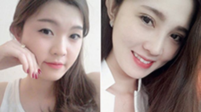 Dạy nghề đốt mụn thịt , nốt ruồi , mụn cốc