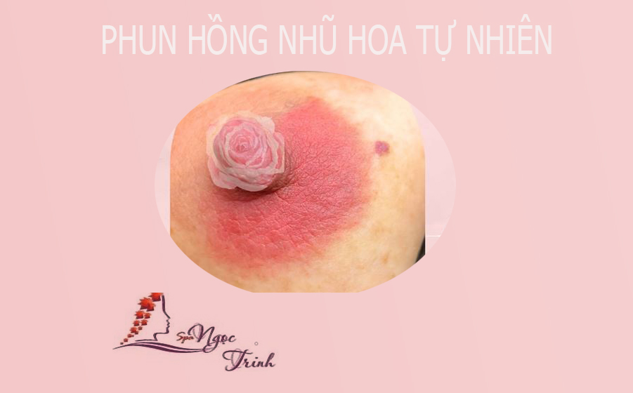Bảng gi&aacute; phun hồng nhũ hoa mới nhất 2026: Liệu c&oacute; chi ph&iacute; ẩn?