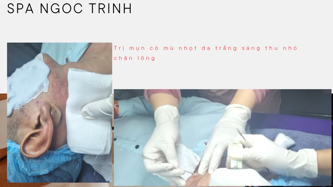 [BẬT M&Iacute;] C&aacute;ch Trị Mụn Tận Gốc Kh&ocirc;ng T&aacute;i Ph&aacute;t: Chia Sẻ Từ Người Trong Cuộc