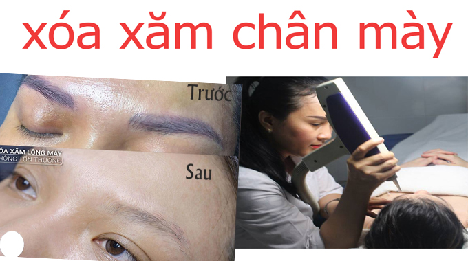 chuyen-vien-spa-ngoc-trinh-dang-xoa-xam-chan-may-bang-laser-picosure