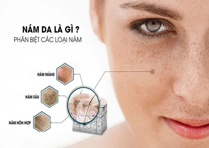  Ngoc Trinh ứng dụng c&ocirc;ng nghệ hiện đại 2026 điều trị n&aacute;m da hiệu quả tận gốc ch&acirc;n s&acirc;u