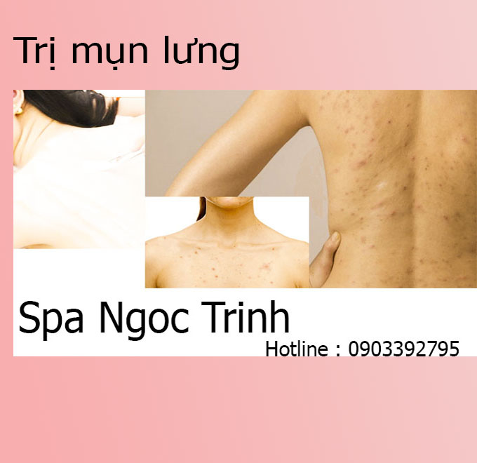 Địa Chỉ Trị Th&acirc;m Mụn Lưng Uy T&iacute;n TPHCM &ndash; Hiệu Quả Nhanh, Gi&aacute; Tốt 2026