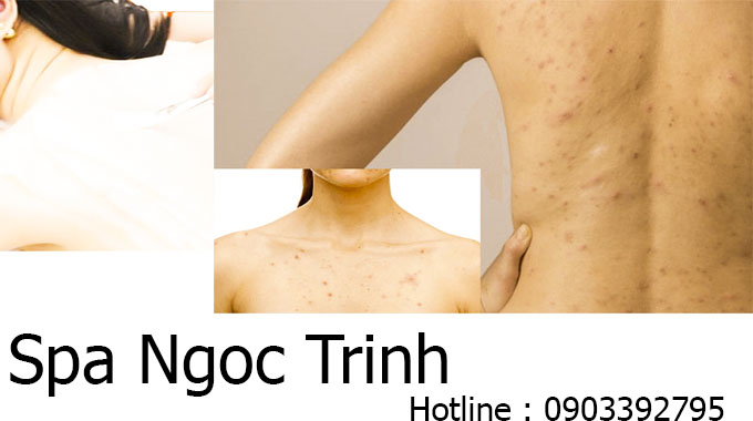 Địa Chỉ Trị Th&acirc;m Mụn Lưng Uy T&iacute;n TPHCM &ndash; Hiệu Quả Nhanh, Gi&aacute; Tốt 2026