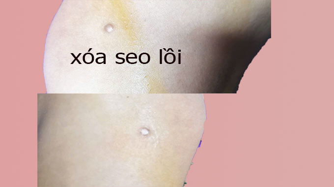 Địa Chỉ Trị Sẹo Lồi Uy T&iacute;n, Thẩm Mỹ Cao Cho Nam V&agrave; Nữ Tại Quận 6