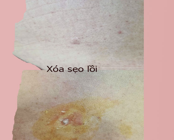 Địa Chỉ Trị Sẹo Lồi Uy T&iacute;n, Thẩm Mỹ Cao Cho Nam V&agrave; Nữ Tại Quận 6