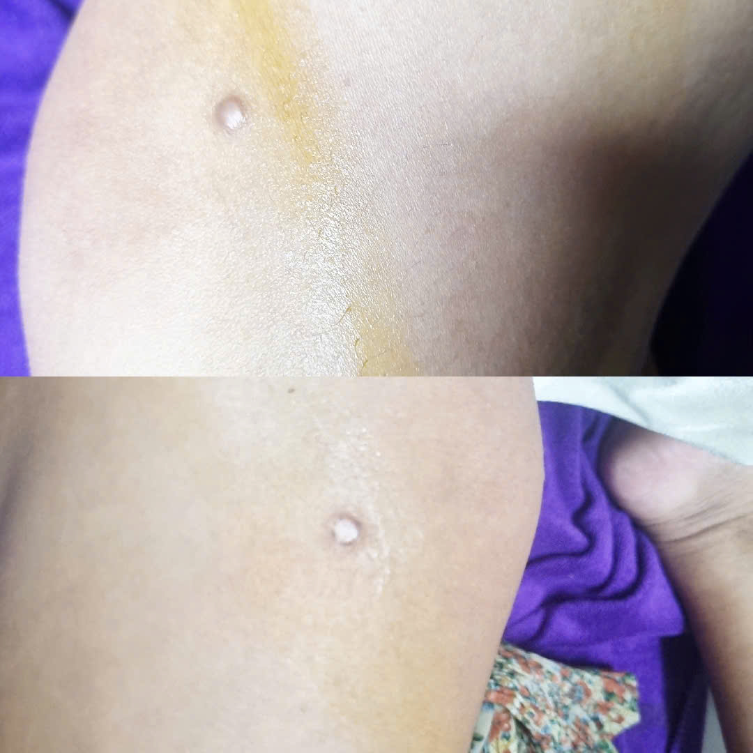 Địa Chỉ Trị Sẹo Lồi Uy T&iacute;n, Thẩm Mỹ Cao Cho Nam V&agrave; Nữ Tại Quận 6