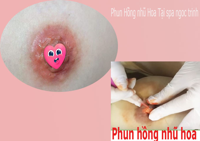 Đừng phun hồng nhũ hoa khi chưa biết mức gi&aacute; n&agrave;y