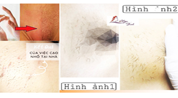 Gi&aacute; triệt l&ocirc;ng v&ugrave;ng k&iacute;n bao nhi&ecirc;u? Bảng gi&aacute; mới nhất 2026 tại Spa Ngọc Trinh