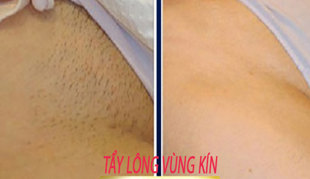 Gi&aacute; triệt l&ocirc;ng v&ugrave;ng k&iacute;n bao nhi&ecirc;u? Bảng gi&aacute; mới nhất 2026 tại Spa Ngọc Trinh