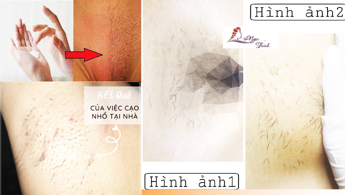 Gi&aacute; triệt l&ocirc;ng v&ugrave;ng k&iacute;n bao nhi&ecirc;u? Bảng gi&aacute; mới nhất 2026 tại Spa Ngọc Trinh