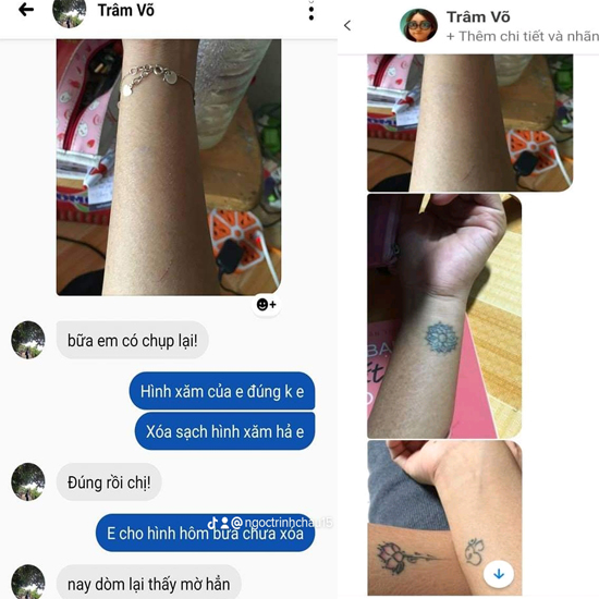 Hiệu quả h&uacute;t sạch gốc mực xăm cũ hỏng v&agrave; mờ th&acirc;m r&otilde; rệt sau liệu tr&igrave;nh x&oacute;a laser