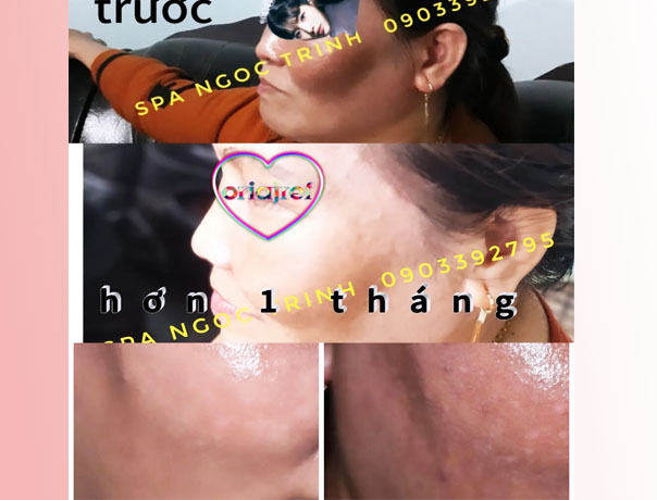 Chuy&ecirc;n vi&ecirc;n đang soi da v&agrave; tư vấn ph&aacute;c đồ trị n&aacute;m chuy&ecirc;n s&acirc;u tại TPHCM