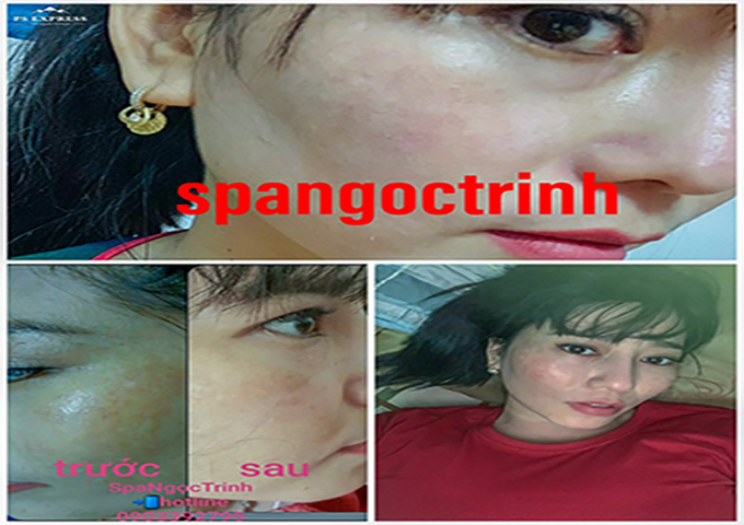 Kết quả trước v&agrave; sau khi trị n&aacute;m t&agrave;n nhang chuẩn y khoa gi&uacute;p da trắng hồng rạng rỡ