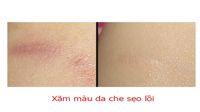 Kết quả xăm che bạch biến loang lổ gi&uacute;p kh&ocirc;i phục sắc tố da tự nhi&ecirc;n