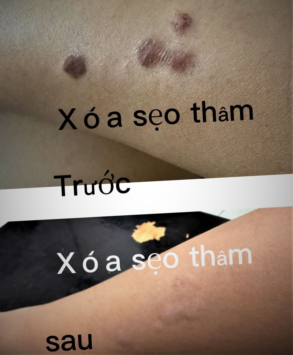 L&agrave;m Mờ Sạm Th&acirc;m Nền M&ocirc; Co Thắt Bằng Xung Plasma Lạnh Quận 6