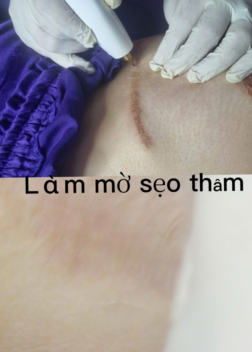 L&agrave;m Mờ Sạm Th&acirc;m Nền M&ocirc; Co Thắt Bằng Xung Plasma Lạnh Quận 6