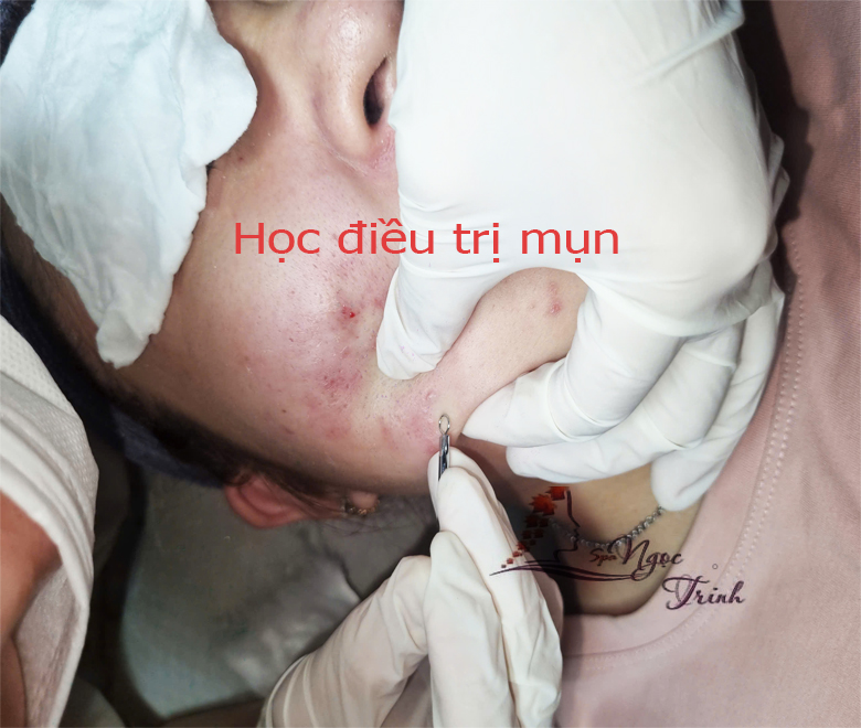 Lấy Nh&acirc;n Mụn Chuẩn Y Khoa Tại Quận 6/Ph&uacute; L&acirc;m &ndash; Spa Ngọc Trinh