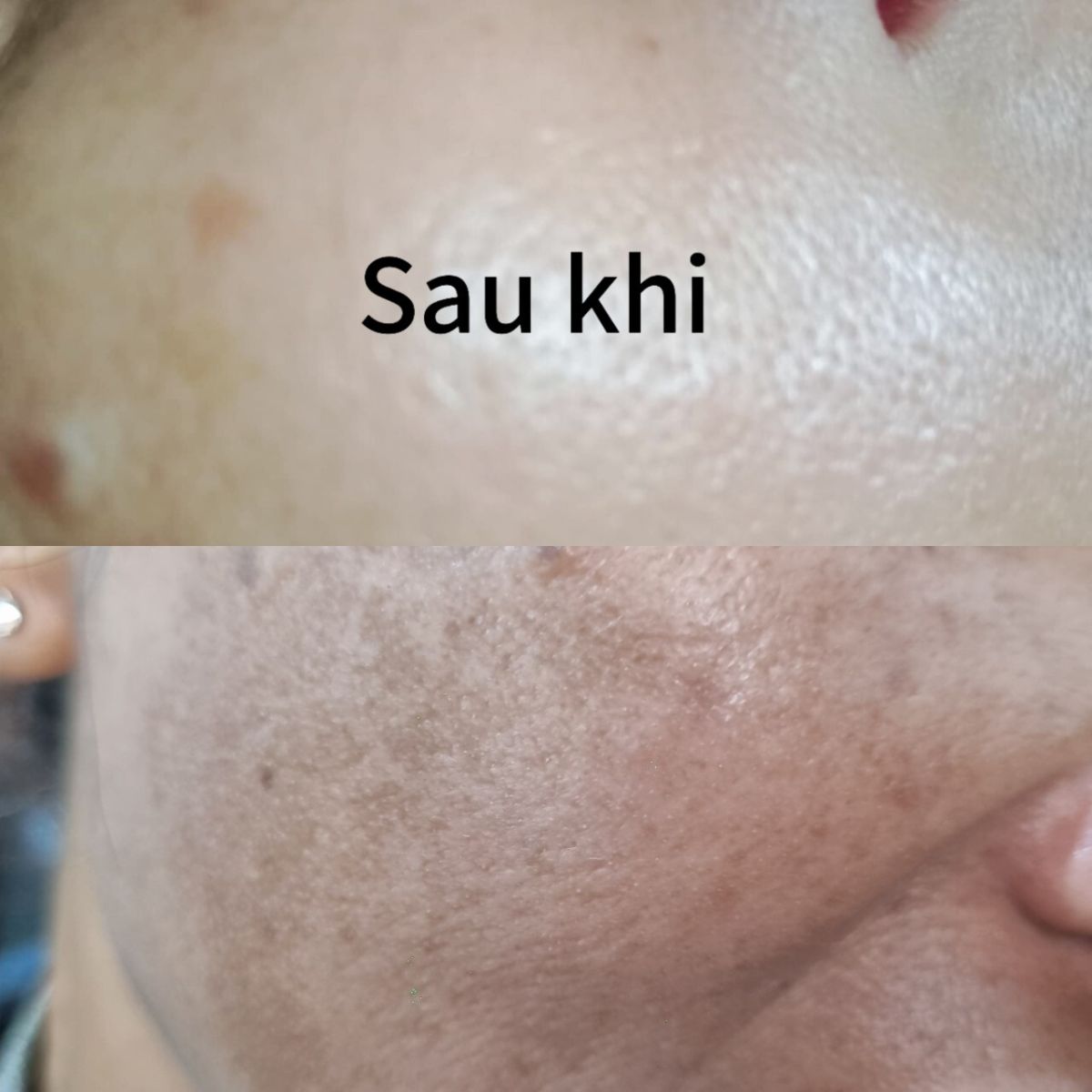 Liệu Tr&igrave;nh Điều Trị N&aacute;m T&agrave;n Nhang Gi&aacute; Bao Nhi&ecirc;u Tại Quận 6