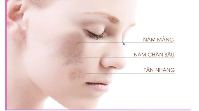 Liệu Tr&igrave;nh Điều Trị N&aacute;m T&agrave;n Nhang Gi&aacute; Bao Nhi&ecirc;u Tại Quận 6