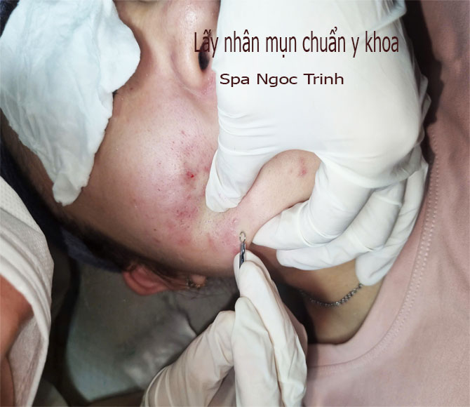 Kỹ thuật vi&ecirc;n thực hiện bước lấy nh&acirc;n mụn chuẩn y khoa kh&ocirc;ng sưng kh&ocirc;ng để lại sẹo th&acirc;m