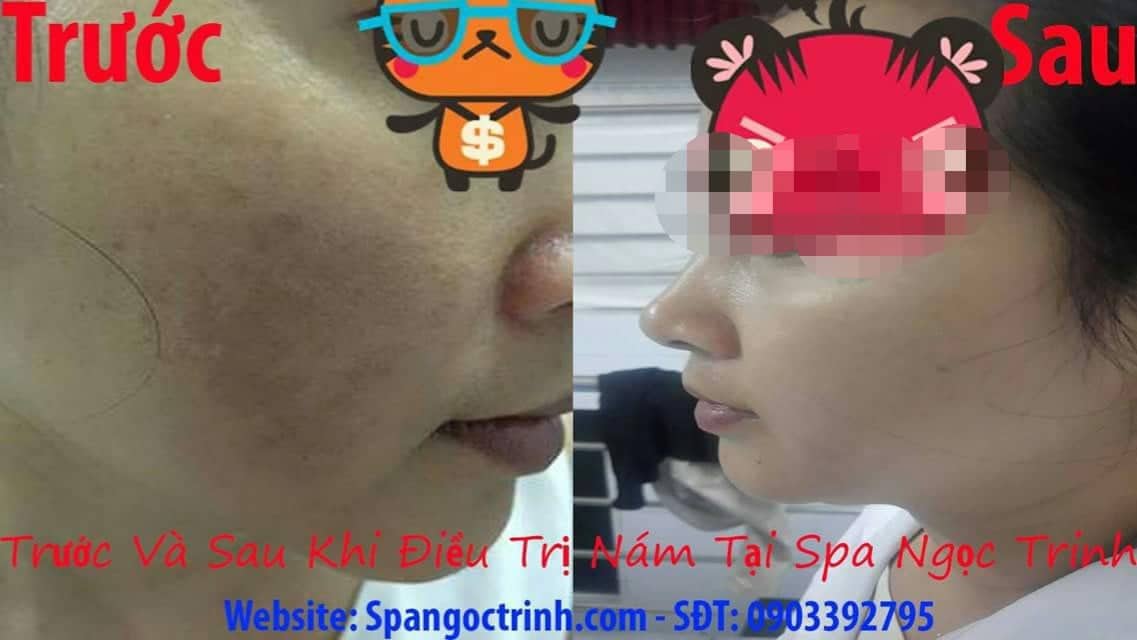 Thoa dưỡng chất phục hồi v&agrave; t&aacute;i sinh l&agrave;n da mộc s&aacute;ng mịn sau liệu tr&igrave;nh trị n&aacute;m