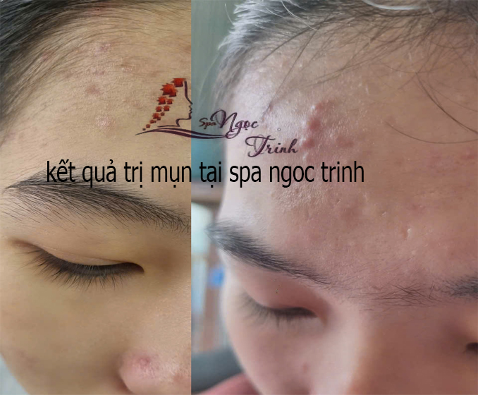 Điện di tinh chất phục hồi t&aacute;i tạo tế b&agrave;o da sau liệu tr&igrave;nh x&oacute;a sẹo th&acirc;m mụn tại TPHCM.