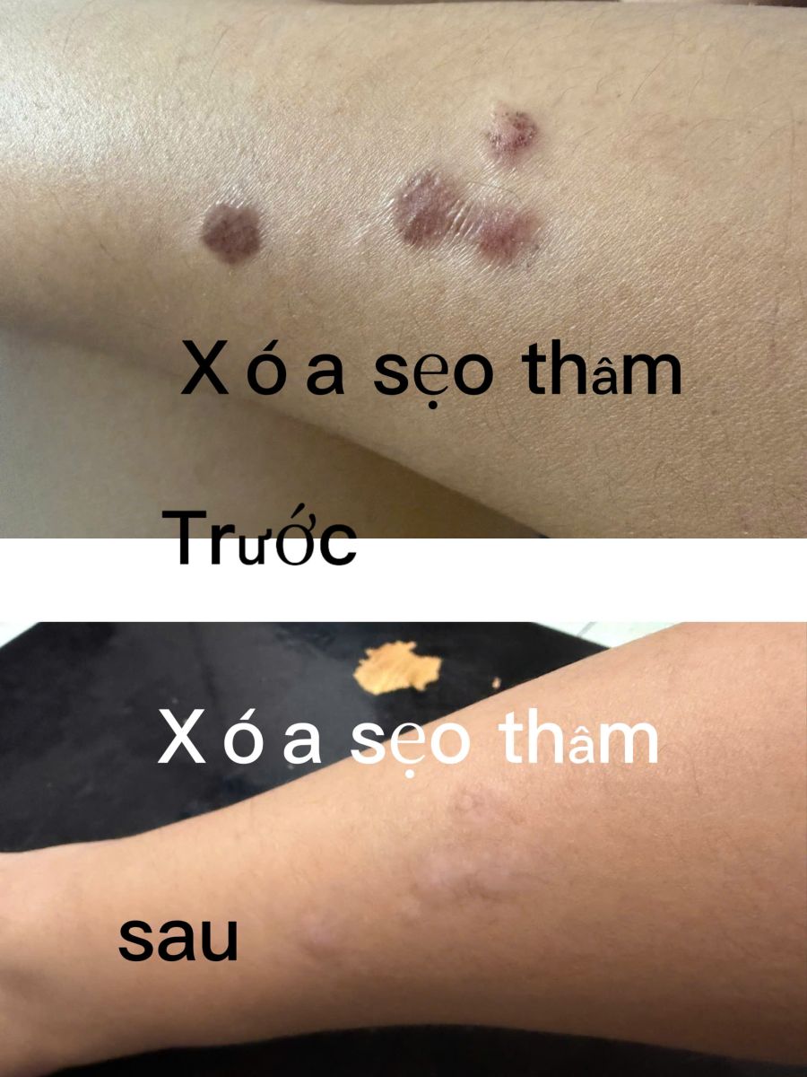 Phục Hồi Sạm Thâm Mông Chân Tay | Spa Ngọc Trinh Quận 6 TPHCM