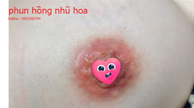 Phun hồng nhũ hoa gi&aacute; bao nhi&ecirc;u