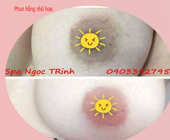 Phun hồng nhũ hoa gi&aacute; bao nhi&ecirc;u