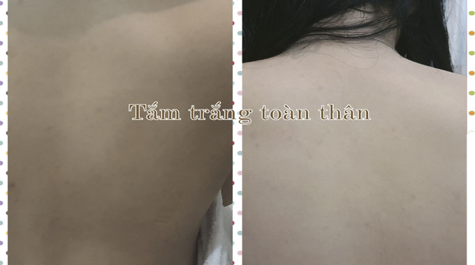 C&ocirc;ng nghệ hấp trắng bằng m&aacute;y phi thuyền hồng ngoại thế hệ mới gi&uacute;p ức chế sắc tố melanin