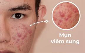 Chuy&ecirc;n gia soi da v&agrave; ph&acirc;n t&iacute;ch t&igrave;nh trạng sẹo th&acirc;m mụn trước khi l&ecirc;n liệu tr&igrave;nh điều trị tại TPHCM.
