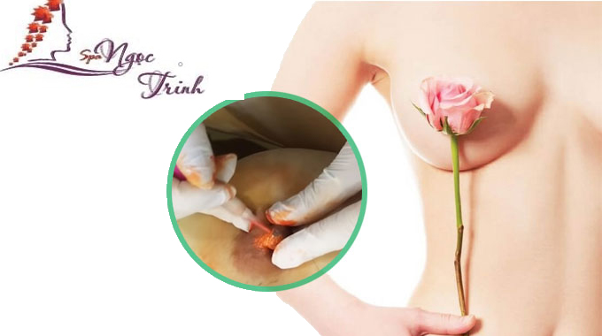 To&agrave;n bộ chi ph&iacute; phun hồng nhũ hoa gồm những g&igrave;? Gi&aacute; chuẩn tại spa