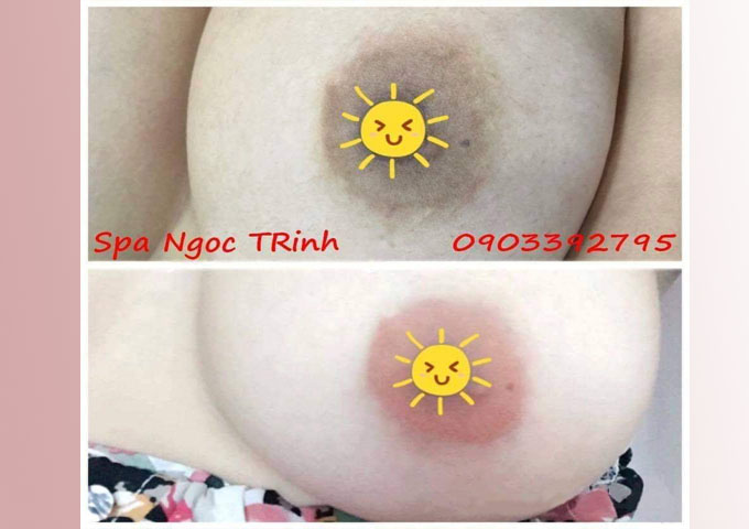 To&agrave;n bộ chi ph&iacute; phun hồng nhũ hoa gồm những g&igrave;? Gi&aacute; chuẩn tại spa
