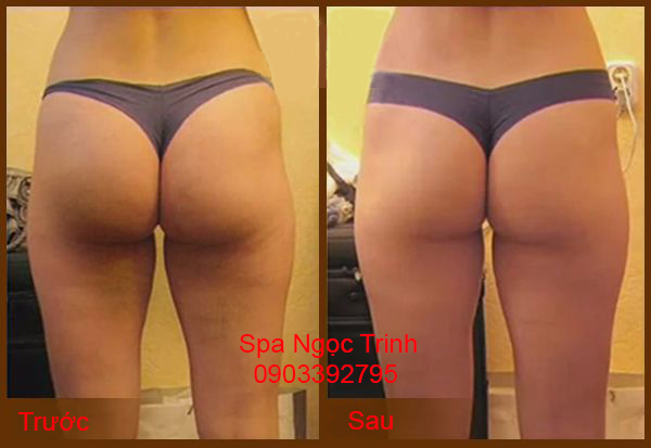 Trị Th&acirc;m M&ocirc;ng Bẹn C&oacute; Hết Kh&ocirc;ng? Chuy&ecirc;n Gia Spa Giải Đ&aacute;p