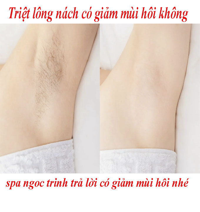 Triệt L&ocirc;ng N&aacute;ch C&oacute; Vĩnh Viễn Kh&ocirc;ng? Giải Đ&aacute;p Từ Chuy&ecirc;n Gia