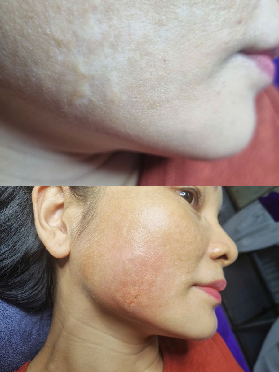Dịch vụ xăm m&agrave;u da che khuyết điểm sẹo v&agrave; rạn da chuy&ecirc;n nghiệp tại TPHCM