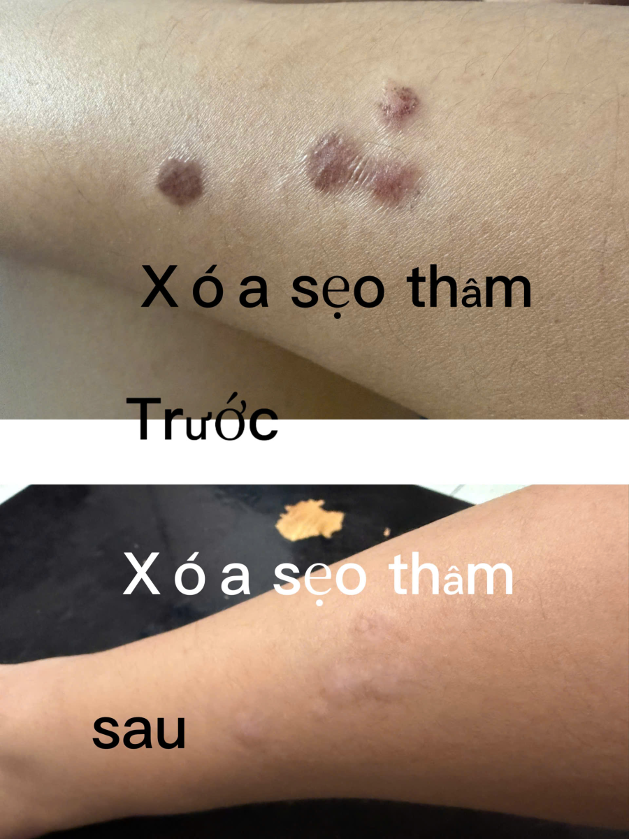 Xăm Màu Da Che Sẹo Phỏng Bô: Giải Pháp Xóa Sẹo Lột Xác Làn Da