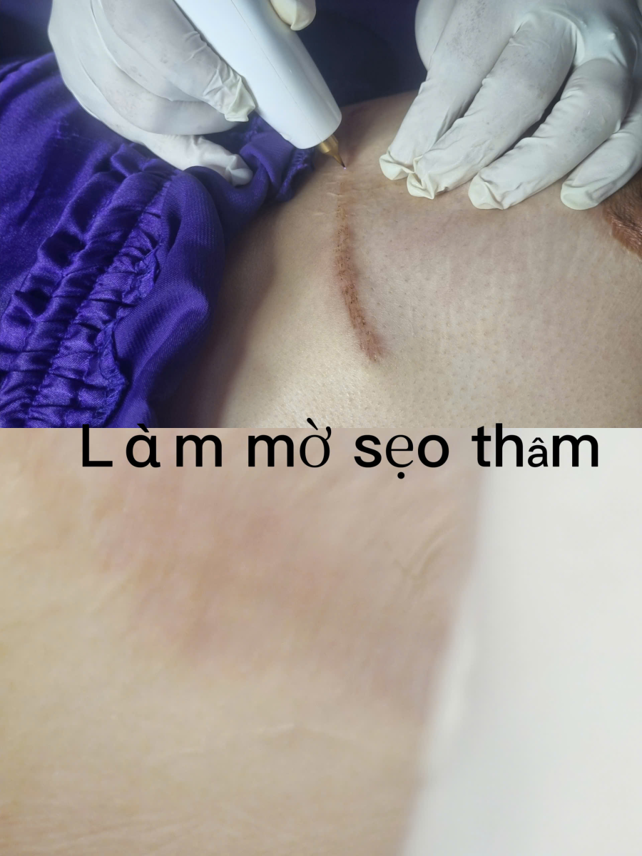 Xăm M&agrave;u Da Che Sẹo Th&acirc;m | Giải Ph&aacute;p San Phẳng Sắc Tố Ngọc Trinh
