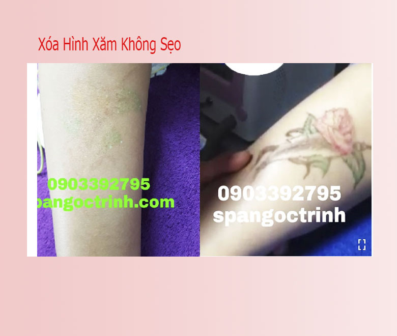 Địa chỉ x&oacute;a h&igrave;nh xăm bằng laser ở đ&acirc;u an to&agrave;n v&agrave; uy t&iacute;n nhất tại TPHCM