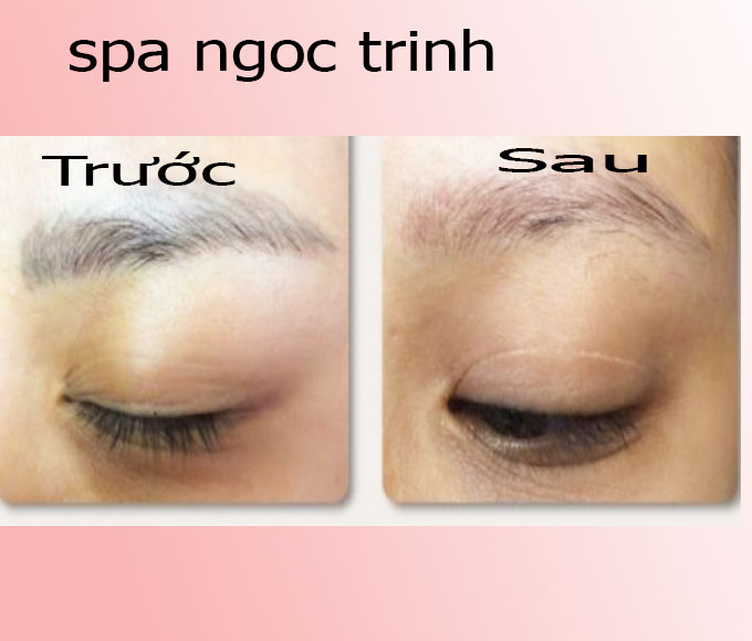 H&igrave;nh ảnh trước v&agrave; sau khi x&oacute;a sửa ch&acirc;n m&agrave;y trổ đỏ tại Spa Ngọc Trinh