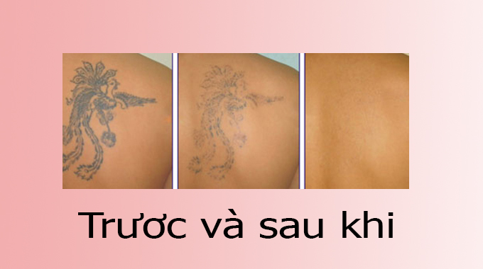 Xóa hình xăm chữ trên cổ tay an toàn, không sẹo bằng Laser công nghệ cao