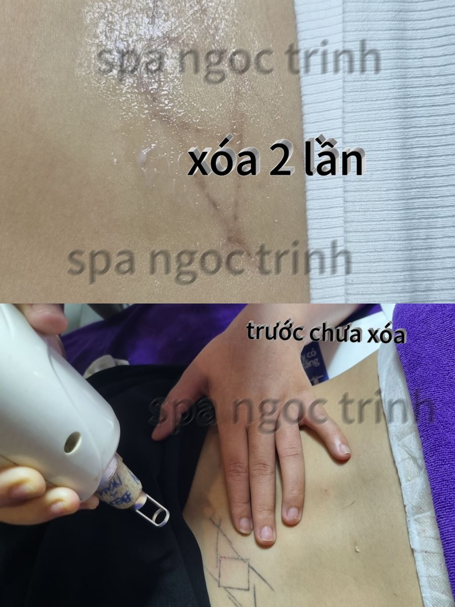X&oacute;a H&igrave;nh Xăm Gần Đ&acirc;y Ở Đ&acirc;u Tốt