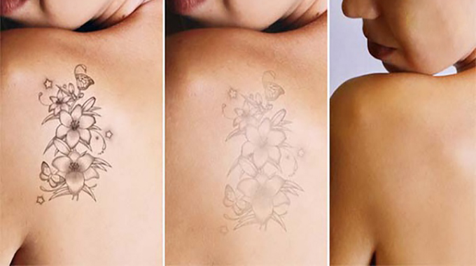 Xóa Hình Xăm Gần Đây Ở Đâu Tốt