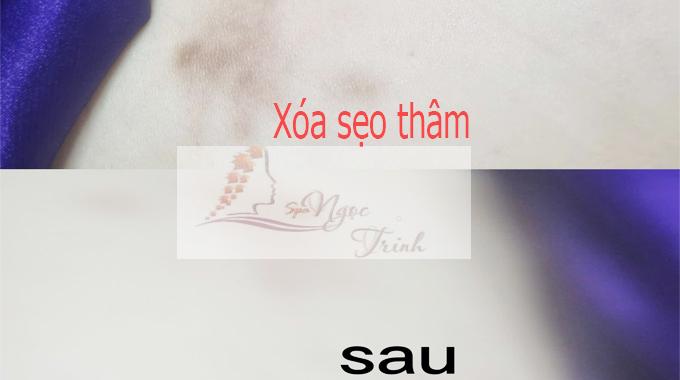 X&oacute;a sẹo th&acirc;m m&ocirc;ng, ch&acirc;n, tay: Giải ph&aacute;p an to&agrave;n, kh&ocirc;ng t&aacute;i ph&aacute;t