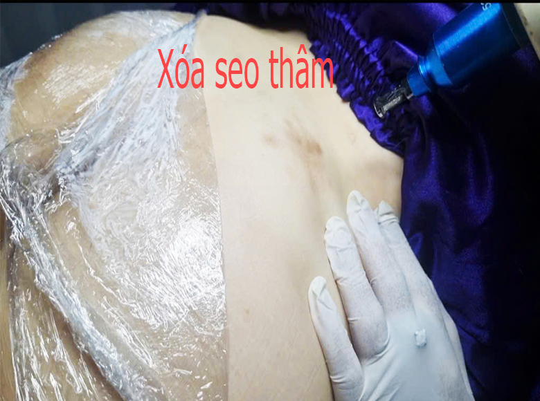 X&oacute;a sẹo th&acirc;m m&ocirc;ng, ch&acirc;n, tay: Giải ph&aacute;p an to&agrave;n, kh&ocirc;ng t&aacute;i ph&aacute;t