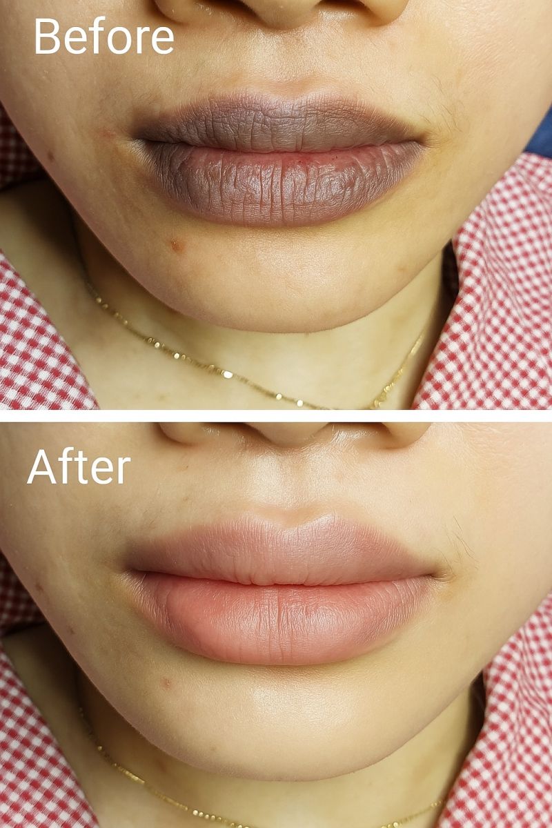 xoa_so_sac_to_melanin_cong_nghe_khu_tham_moi