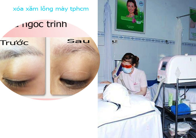 X&oacute;a Xăm L&ocirc;ng M&agrave;y C&ocirc;ng Nghệ Mới